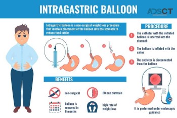  Transform Your Weight Loss Journey with Intragastric Balloon – Call Us Today!